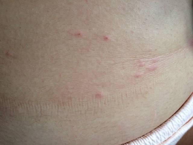 身上起了好多小痘痘痒死了_有没有宝妈有同样