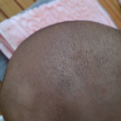 宝宝满月理发之后头顶出现几处白色斑块,白色