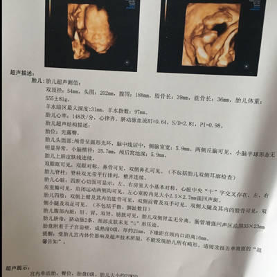 今天去产检照四维B超了,查出来有肠管强回声2