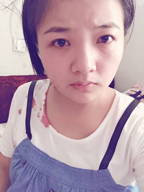 怀孕五个月之内被打两次多处淤伤脸部浮肿_我