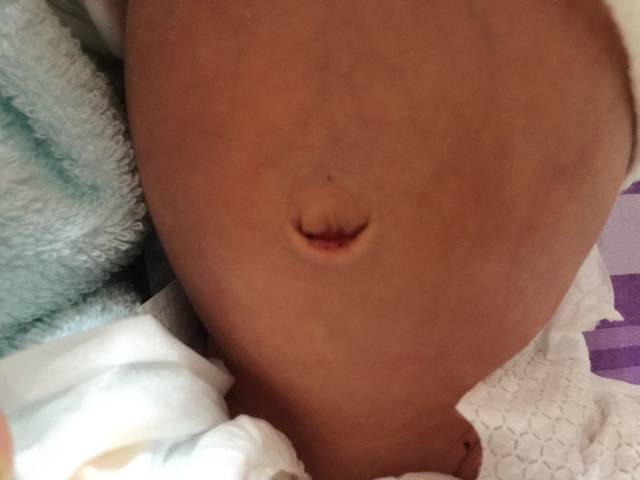 急!脐带脱落后出血!_宝宝脐带脱落3天后,肚脐上