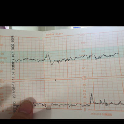 这个胎心监护结果怎麼样,有谁会帮忙解读