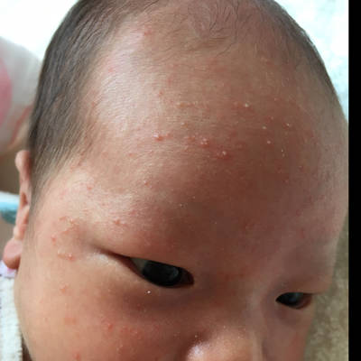 宝宝脸头上长满了点点,像粉刺一样的白点点,也