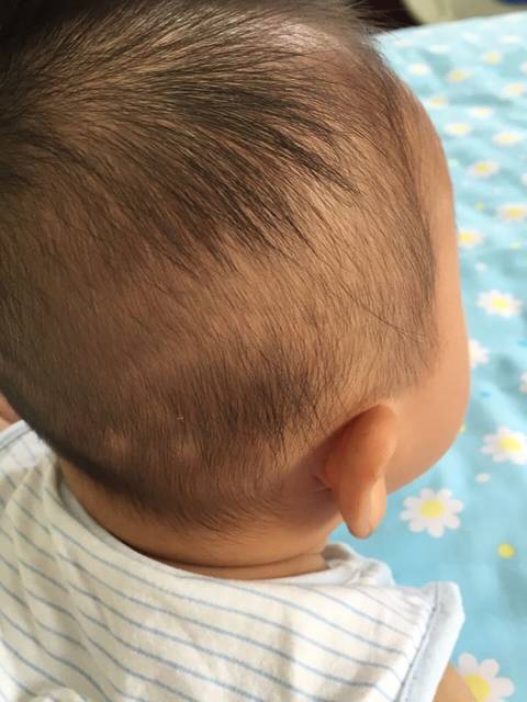 宝宝头上掉了两块头发…_今天一早起来发现宝