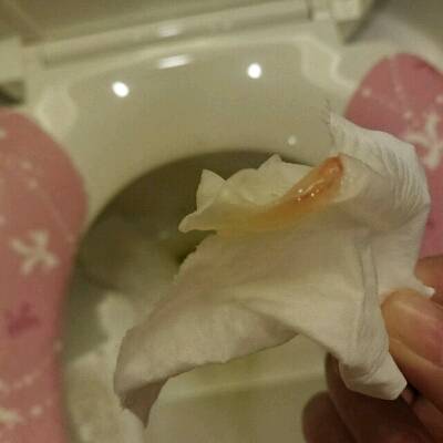 到今天连续四天流咖啡色的,早上上厕所尿尿,就掉下这个,请问这是孕囊