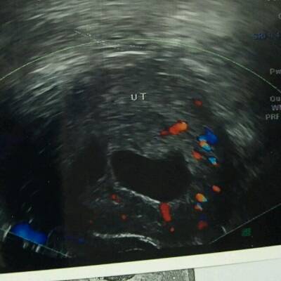 您好 怀孕第一次照B超,说胎囊周边可见液性暗