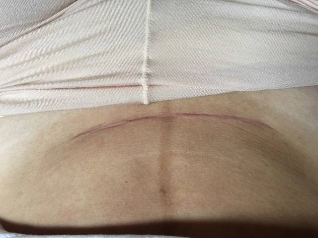 剖腹产疤痕增生