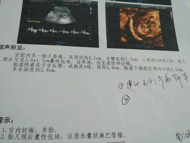 NT检查发现胎儿颈部有淋巴水囊瘤_NT检查发