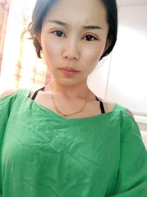 做了全切双眼皮抽脂去皮加开眼角第三天,恢复