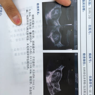 我月经不正常,8月20号验孕棒测的怀孕,23号做