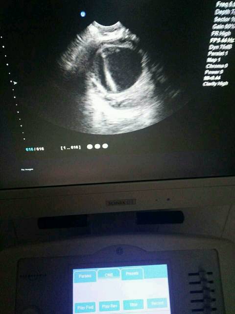 卵泡不破变囊肿,怎么办_多囊,打尿促,今天去监