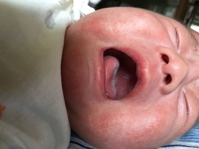 宝宝上颚白色坑是怎么回事_宝宝一个多月了,上