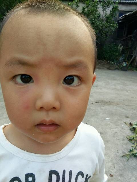 宝宝眼睛肿了怎么办,怀疑虫咬的_宝宝昨天脸上