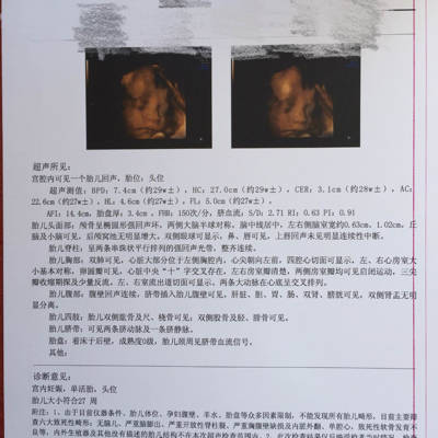 今天26周+2去做四维,大夫说胎儿偏大,尤其是头