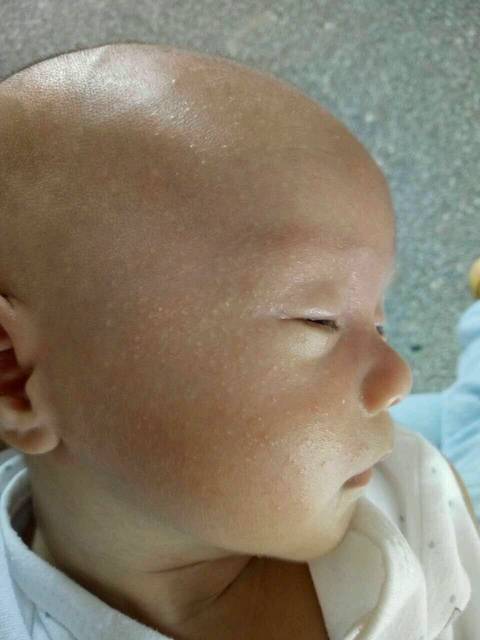 宝宝湿疹_宝宝刚刚满月 这三天脸上长满了小点