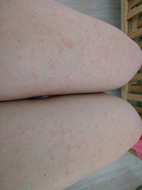 刨腹产后起疙瘩,奇痒无比!(有图)_生完小孩23天