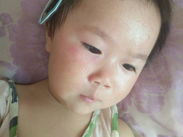 3岁的宝贝眼睛周围老长红点_宝宝眼睛周围老