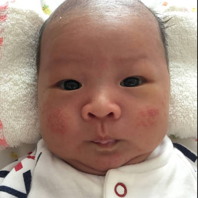 9月6号出生的,12号脸上起了红点点,看起来有点