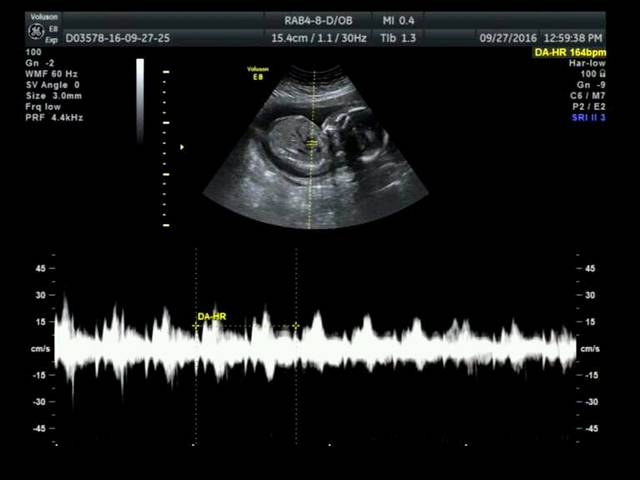 b超怎样分辨男女?_哪位朋友会看b超图,分辨男孩女孩?_宝宝树