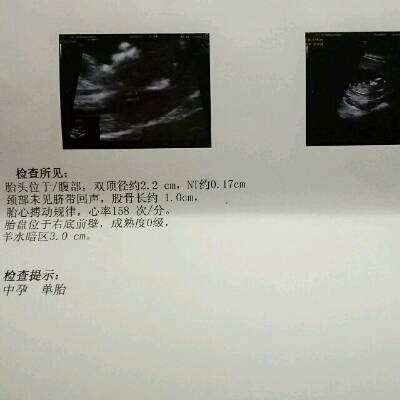 十二周加三天做的彩超,宝妈们看的出来是男孩女孩嘛