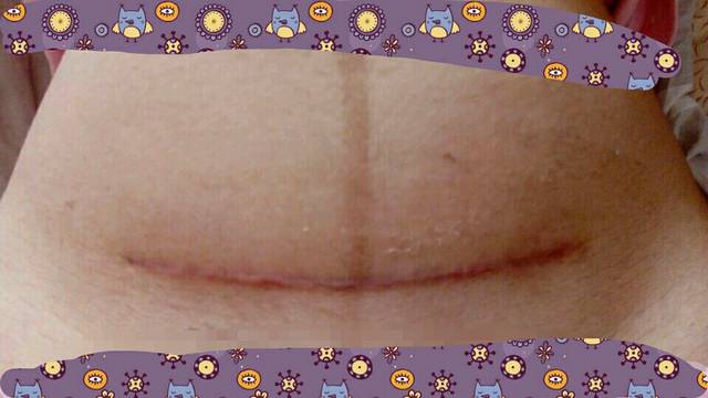 仁济东院剖腹产刀口恢复_今天25天了,刀口里面还是隐隐的疼!_宝宝树