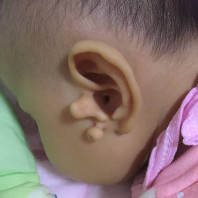 宝宝长附耳，想去除，怎么办呢