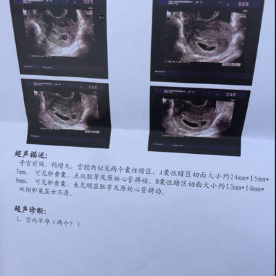 怀孕6+3、今天阴超检查医生说有两个孕囊、说一个有胎心一个没有、大小不一样、谁能帮我看看单子、什么意思
