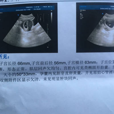 怀孕40天的双胞胎的图,怀双胞胎40天孕囊图片 不会是双胞胎吧.