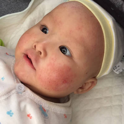 宝宝这一两个月老是反复长湿疹,过敏的食物也