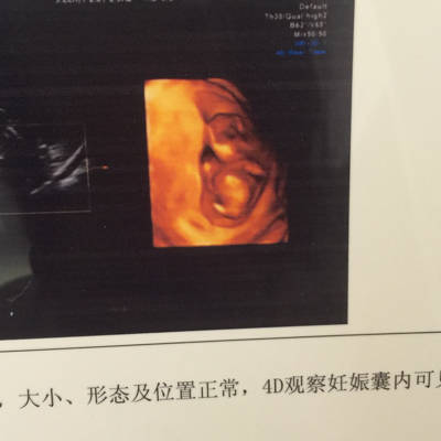 孕12周2天做的nt!宝宝很健康!能看出男孩女孩吗?