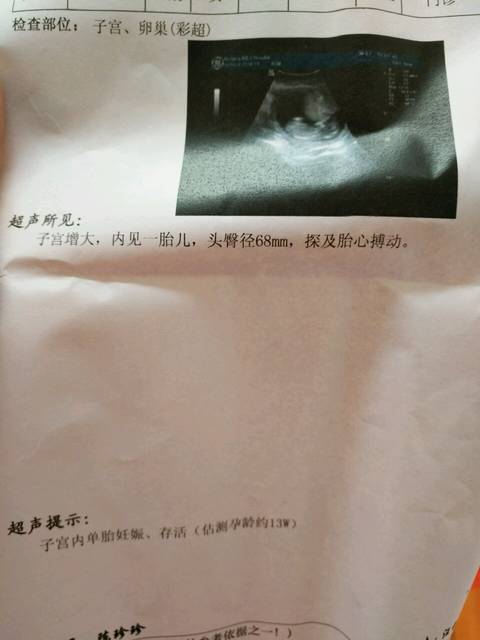 今天去做B超,我以为是做NT,过一个月又说做B