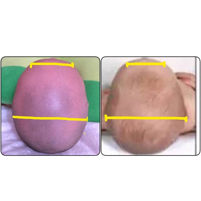 宝宝爱侧睡,头型睡成尖头了,还能睡圆吗?