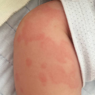 前两天给宝宝换尿不湿的时候突然发现宝宝屁股上起了一片这样的红斑