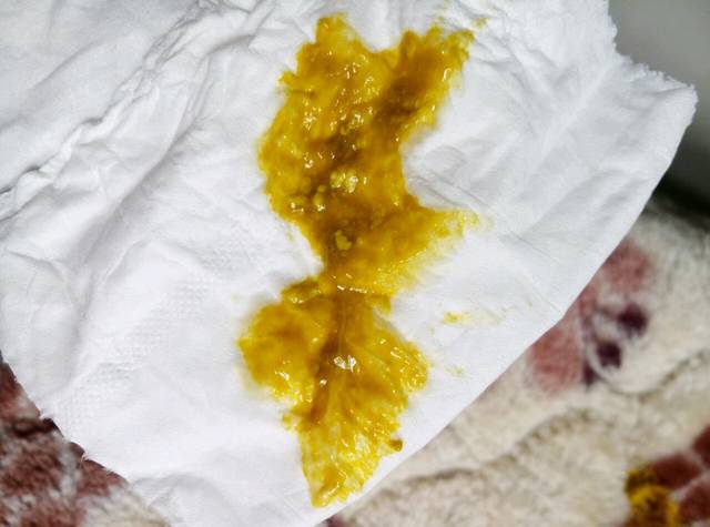 有谁知道这是不是4个月宝宝拉的正常便便,_宝
