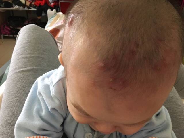 宝宝长疖子怎么办?各位娘娘棒棒忙,太多了!担