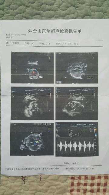 求助~胎儿左肾积水,右肾是多囊性发育不良肾!