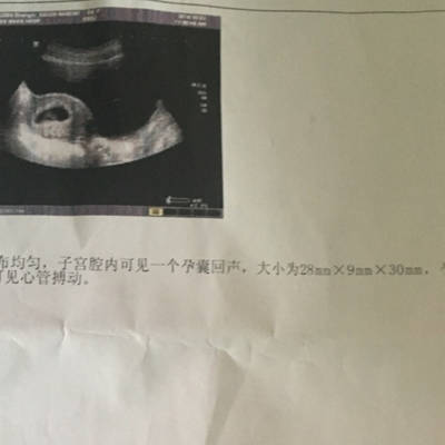 怀孕45天左右做的B超、孕囊形状是男宝还是女