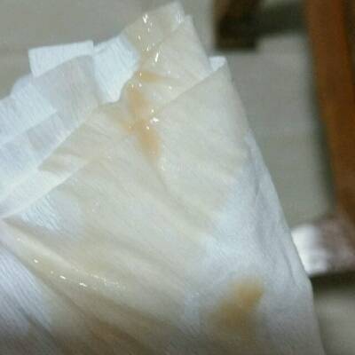 泌物有异常,之前有过褐色分泌物正在吃中药保