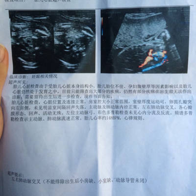 孕25 3,单脐动脉,刚做了心超显示左右肺动脉交叉这个严重吗?