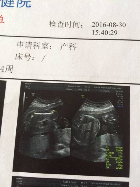 b超单上胎儿两腿中间的白点是男孩的生殖器官