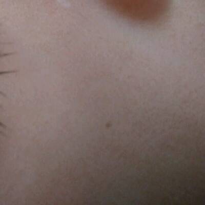 宝宝脸上长了一个小黑点,很浅,可有擦不掉,怎么办