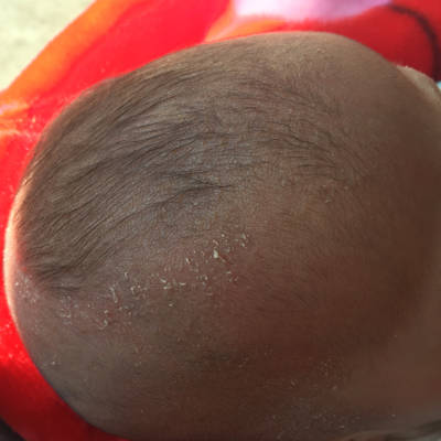 宝宝刚满月几天,今天剃胎头的时候才发现头上