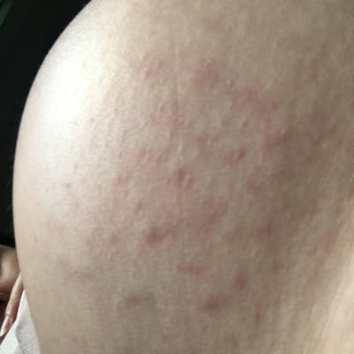 请问宝妈们,这个要长纹的节奏吗?_育儿问答_宝宝树