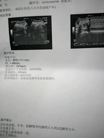 30周b超单_双顶径7.9、股骨长5.4,大夫说腿太