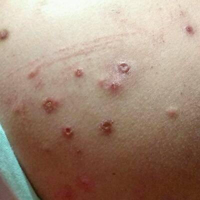 孕期屁股老是长了小红疙瘩,又红又痒,请问有宝