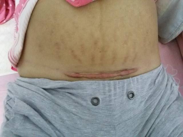 剖腹产后有疤痕增生_宝宝现在是5个月21天宝