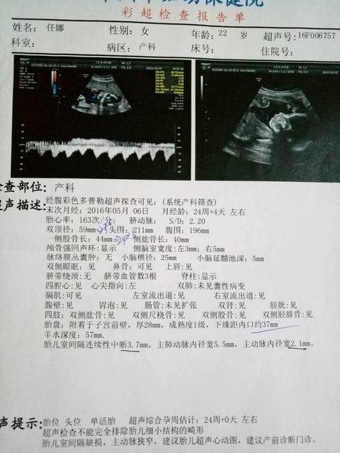 孕24周胎儿室间隔缺损并主动脉狭窄_24周做b