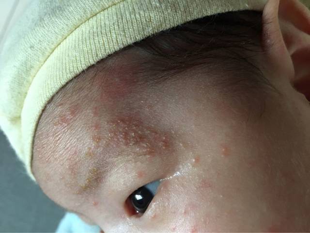 宝宝脸上长了很多红色的疹子_宝宝脸上长了很