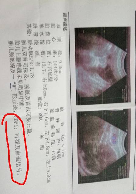 求解GDFI:可探及血流信号_怀孕37周b超单显示