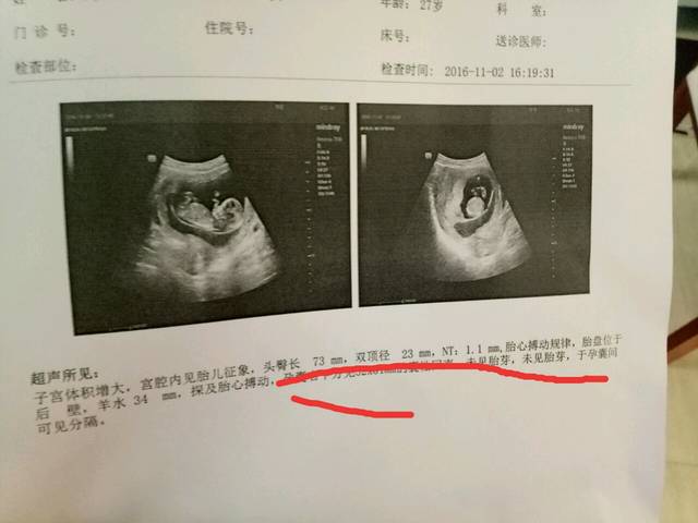 怀孕12周,双胞胎一个胎停,一个发育正常,帮忙看